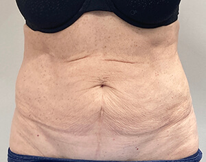 Tummy Tuck Before